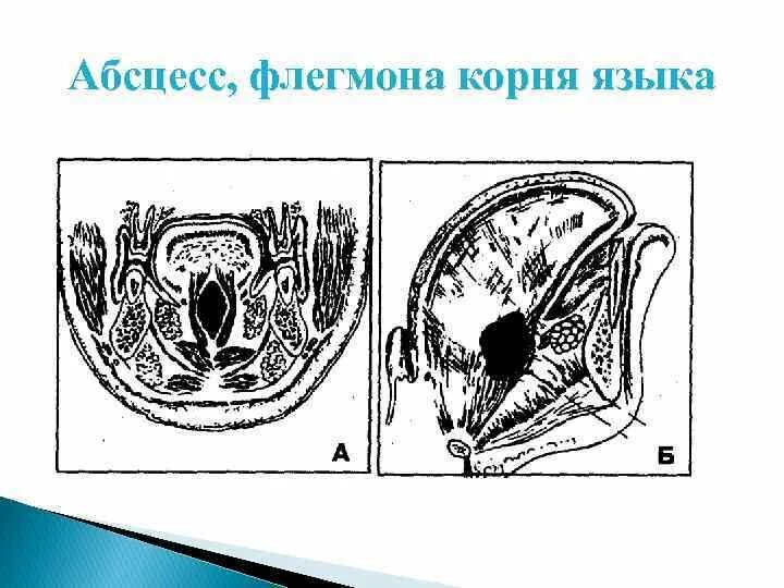 Абсцесс желобка. Границы клетчаточного пространства корня языка. флегмона корня языка дренируется разрезом. флегмона корня языка тела. вскрытие абсцесса корня языка.