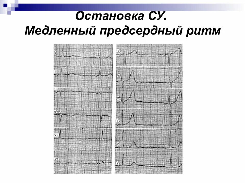 Экг при нижнепредсердном ритме. Эктопический правопредсердный ритм на экг. Эктопический предсердный ритм на экг. Эктопический предсердный ритм на экг. Предсердный ритм сердца на экг.
