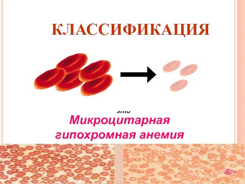 Макроцитарная гипохромная анемия. Микроцитарная гиперхромная анемия. Гипохромные микроцитарные анемии. Железодефицитная анемия микроцитарная.