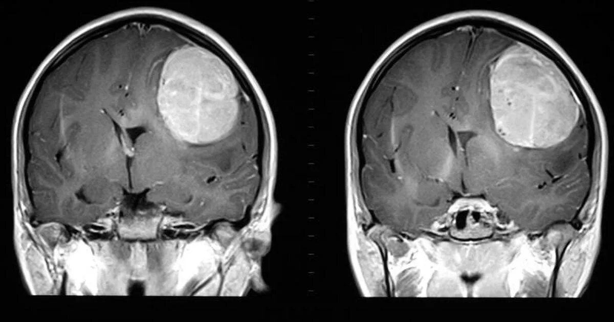 Глиобластома головного мозга на кт и мрт. Глиобластома височно теменной области. Как выглядит опухоль головного мозга.