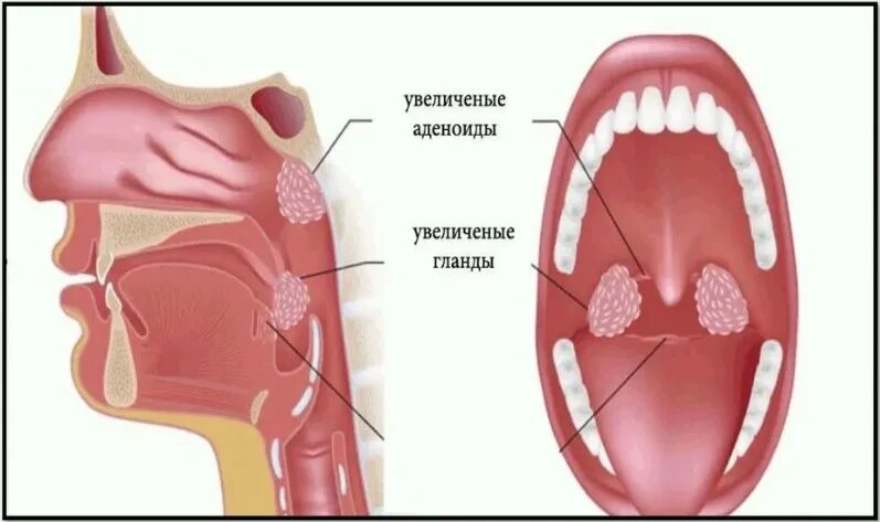 Аденоиды признаки