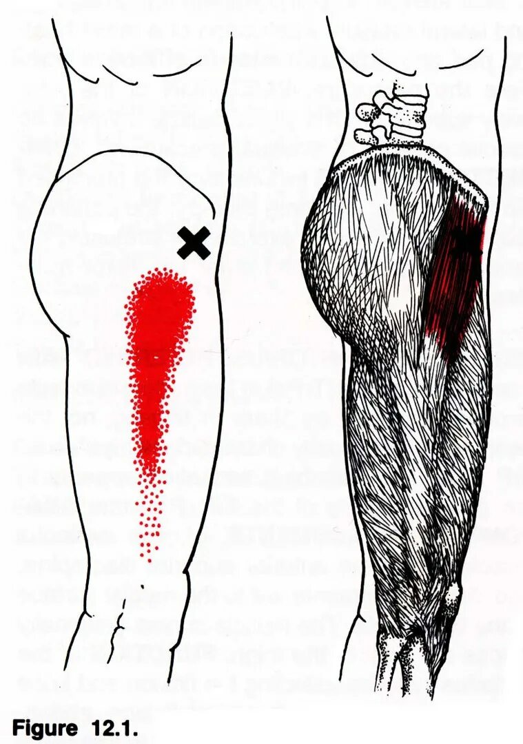 Сильные боли в области бедра. Напрягатель широкой фасции триггерные точки. Напрягатель широкой фасции бедра. Триггерные точки бедра. Напрягатель широкой фасции анатомия.