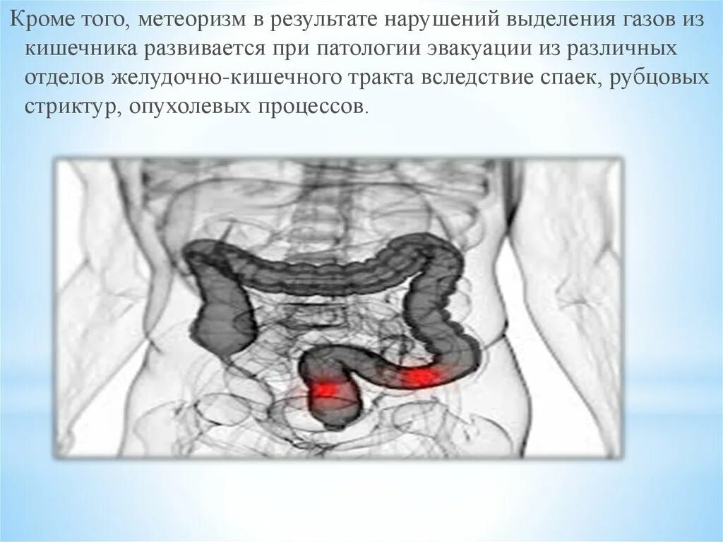 Вздутие кишечника какого. Метеоризм в ободочной кишке. симптомы при метеоризме кишечника. метеоризм толстого кишечника.