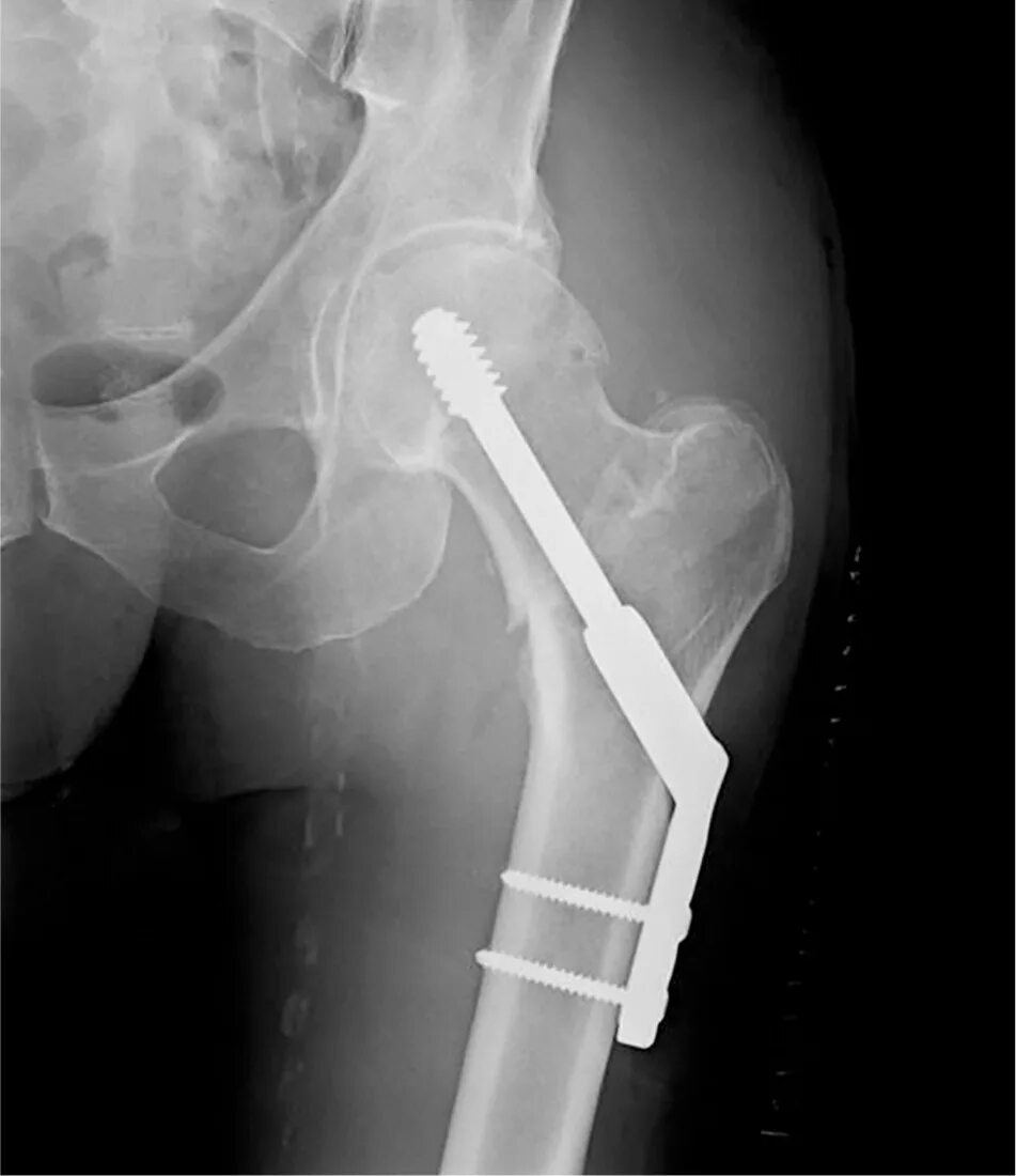 Внутрикостный остеосинтез шейки бедра. Перелом шейки бедра остеосинтез. Субкапитальный перелом шейки бедра рентген. Перелом шейки бедра остеосинтез рентген. Перелом шейки бедра тазобедренного сустава