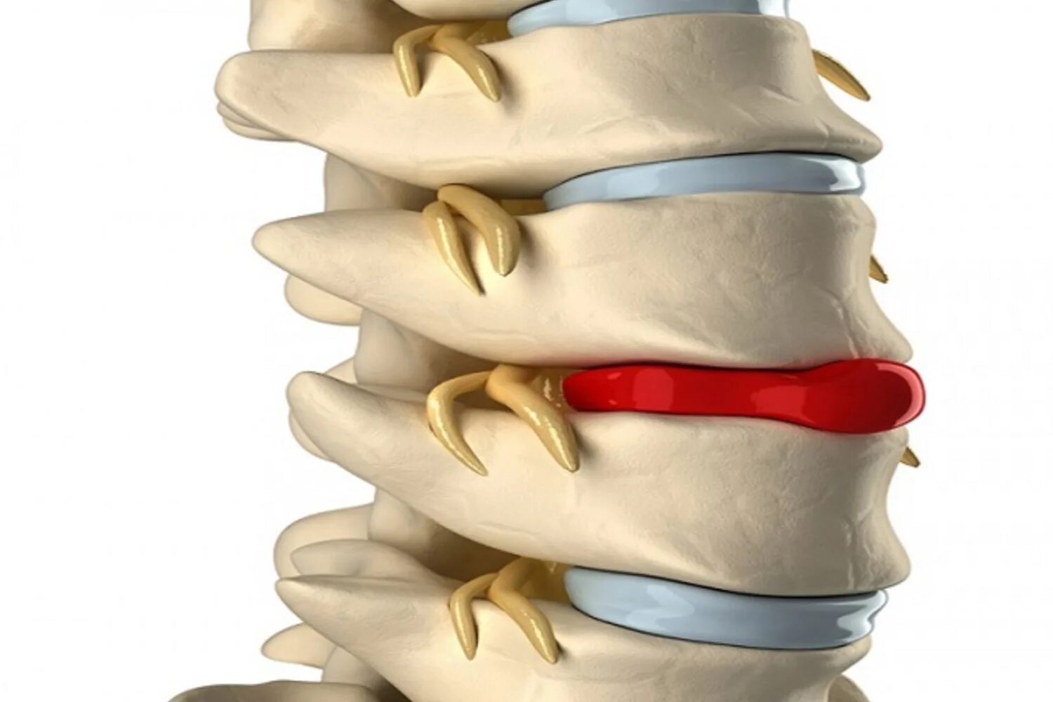Межпозвонковая грыжа поясничного лечение. Грыжа межпозвоночного диска. Грыжа межпозвонквого дискапозвонок. Междисковая грыжа позвоночника. Грыжи и протрузии позвоночника.