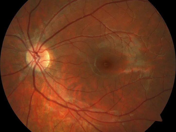 Центральная хориоретинопатия сетчатки. Центральная хориоретинальная дистрофия сетчатки. Центральная серозная хориоретинопатия глаза. Центральная серозная отслойка сетчатки.