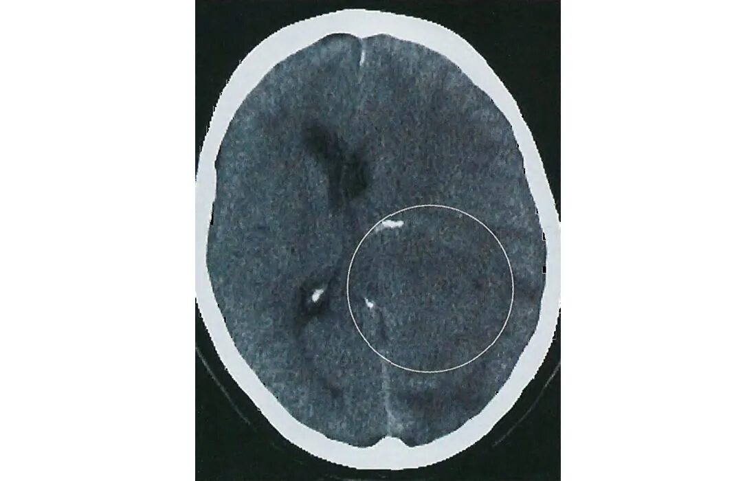 мрт. кт головного мозга кровоизлияние. кт мозга уфа. внутримозговое кровоизлияние кт. кт томограмма головного мозга.