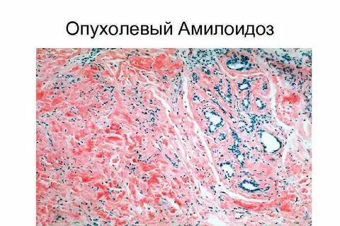 Амилоидоз ткани