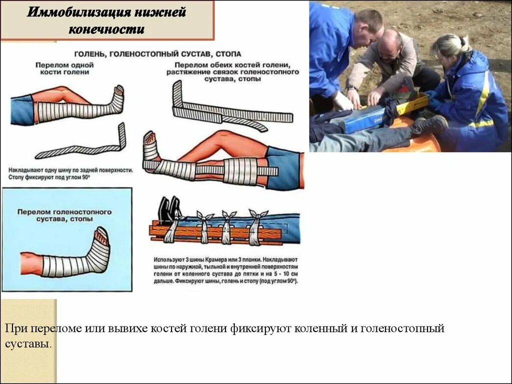 Иммобилизация костей голени алгоритм. Транспортная иммобилизация костей голени. Транспортная иммобилизация костей нижних конечностей алгоритм. 2. Транспортная иммобилизация при переломе костей голени..