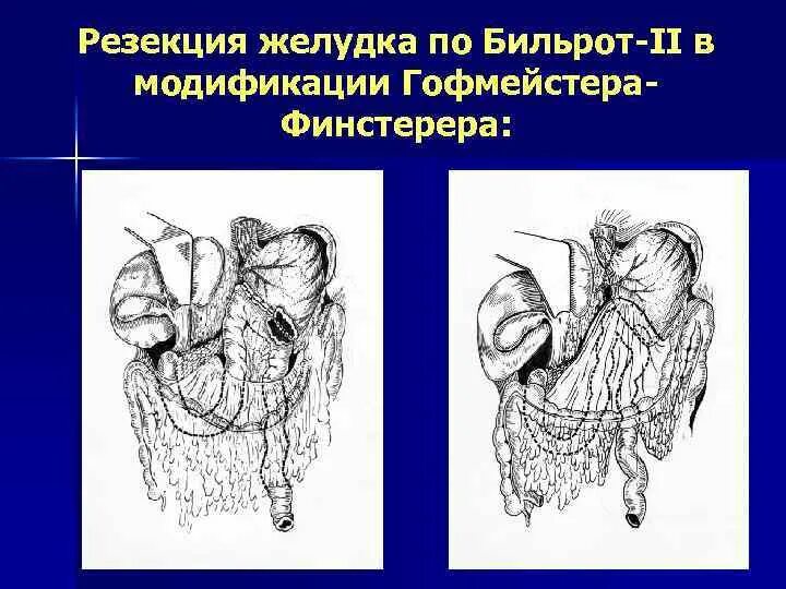 Резекция желудка по гофмейстеру. Бильрот 2 по гофмейстеру финстереру. операция бильрот 2 в модификации гофмейстера финстерера. модификация бильрот 2 по гофмейстеру. гофмейстер финстереру резекция желудка.