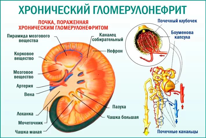 Заболевание почек гломерулонефрит. Гломерулонефрит воспаление клубочков почки. Поражение клубочков гломерулонефрит. Гломерулонефрит клубочковый нефрит. Хронический гломерулонефрит (хгн).