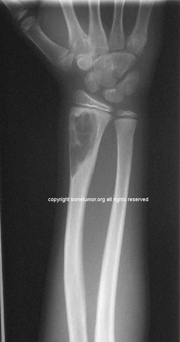 киста кости мкб