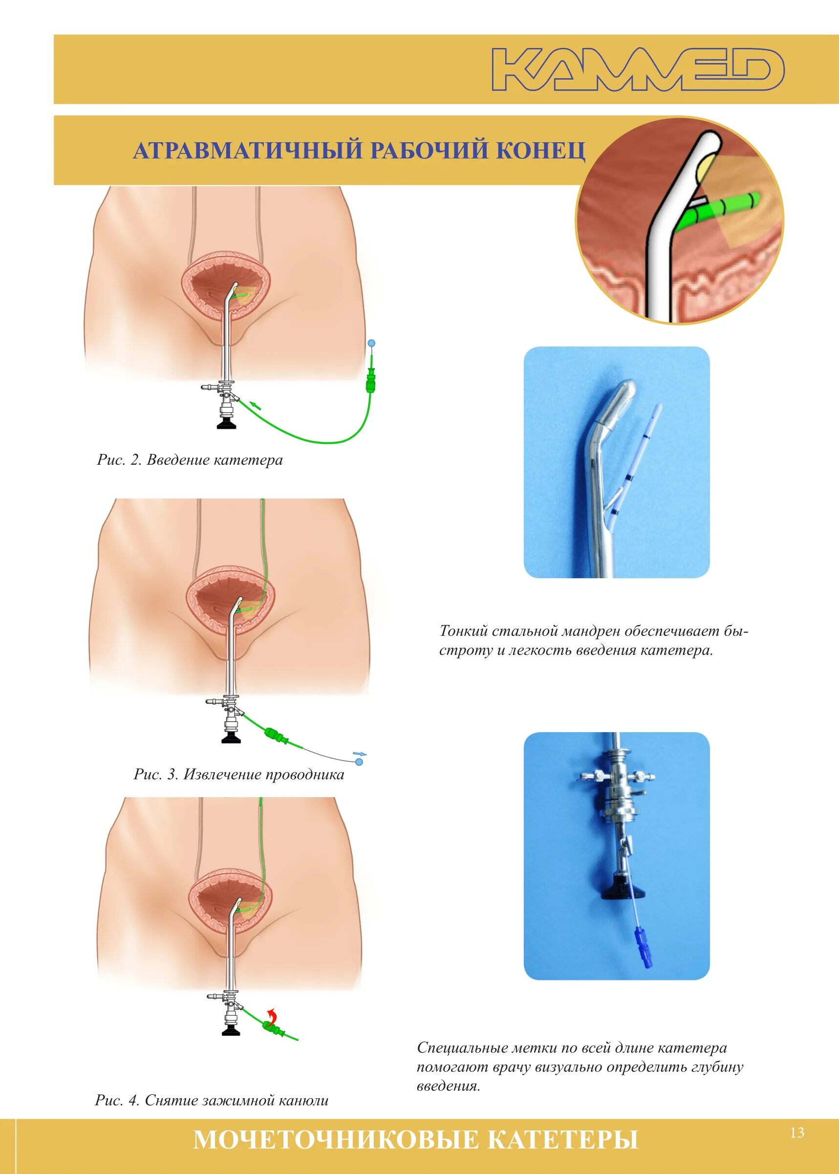 Катетеризация мочеточника. Катетер стент мочеточниковый. Мочеточниковый катетер 16. Внутренний катетер мочеточника. Катетеризация мочеточника показания.