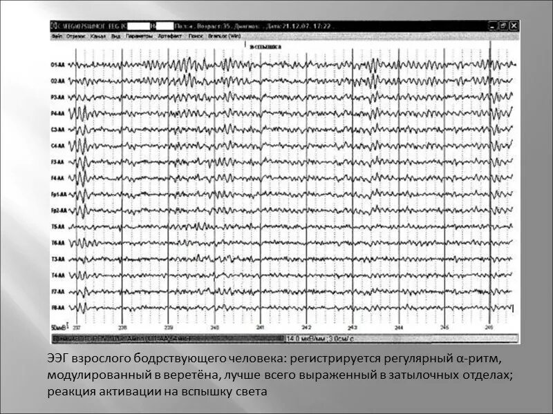 Описание ээг. ЭЭГ взрослого человека. Реакция активации ЭЭГ. Протокол ЭЭГ. Заключение ЭЭГ.