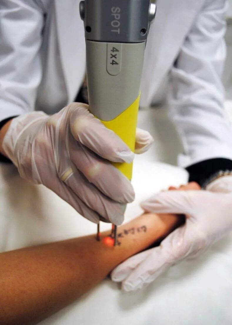 Удаление лазером митино. Лазерная эпиляция quanta system duetto. Лазерная депиляция шея. Эпиляция лица для женщин. Как на яйца делают тату лазером.