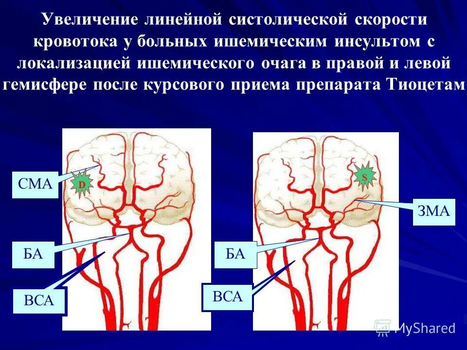 Инсульты задания. Ишемический инсульт поражения артерий. Ишемический инсульт в бассейне внутренней сонной артерии. ОНМК В задней мозговой артерии. Инсульт левой средней мозговой артерии.