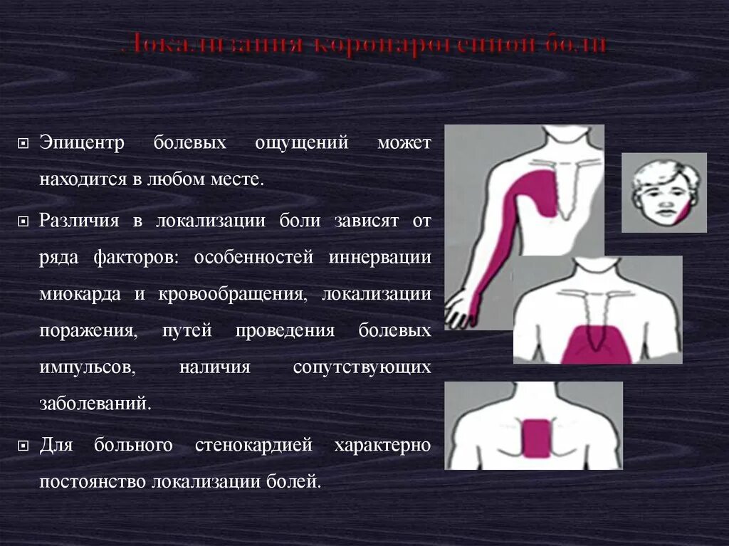 Заболевания локализация боли. Локализация боли в сердце. Локализация сердечных болей. Инфаркт миокарда локализация боли. Локализация боли при стенокардии.