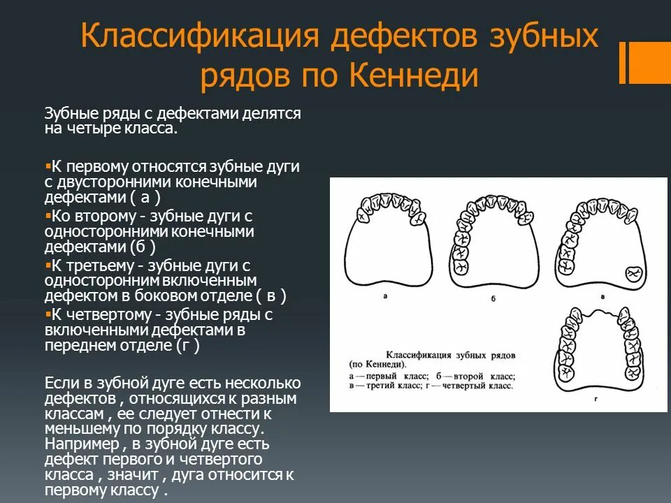 2 Класс 1 подкласс по Кеннеди. Классификация по Кеннеди и Гаврилову. Классификация зубных дефектов по Кеннеди с ПОДКЛАССАМИ. Дефекты зубных рядов по Кеннеди.