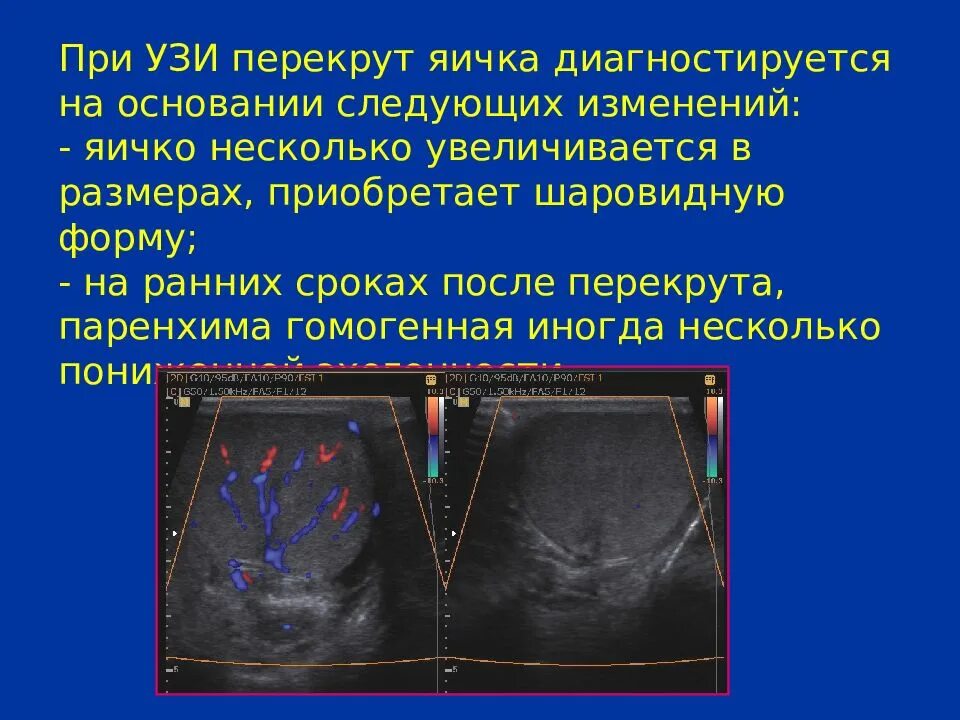 Что делать если болит яйцо у мужчины. УЗИ признаки перекрута яичка. УЗИ при перекруте яичка. Перекрут яичка эхограммы.