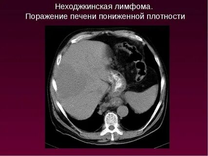 Локализация лимфом