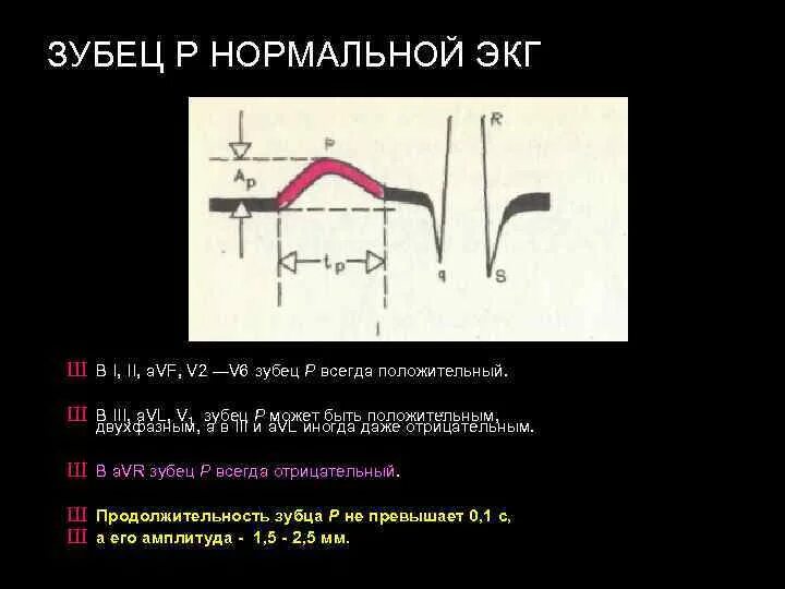 Расщепление зубца. Расщепление зубца r на экг. зазубренный зубец r на экг. отрицательный зубец р в 2 3 avf. зубец r расщеплен во 2 и avf.