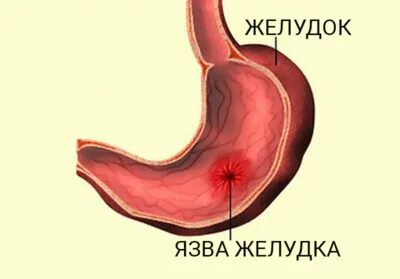 Язва желудка симптомы у женщин после 50