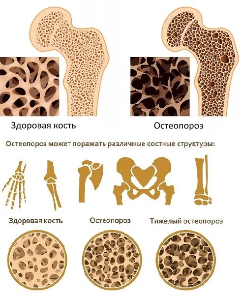 Изменение структуры кости. Пороз костеостепороз костей. Остеопороз патологическая анатомия. Остеопороз трубчатых костей.