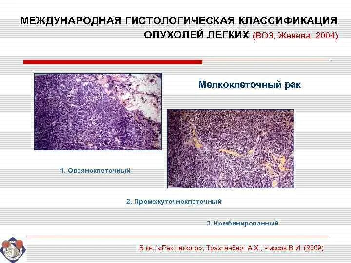 Рак легкого гистологические. Рак легкого гистологические