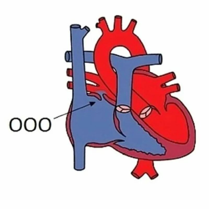 Окно в сердце у ребенка. Незаращение овального окна. Врожденный порок сердца открытое овальное окно. Пороки сердца у детей незаращение овального окна. Открытое овал.ное окно.