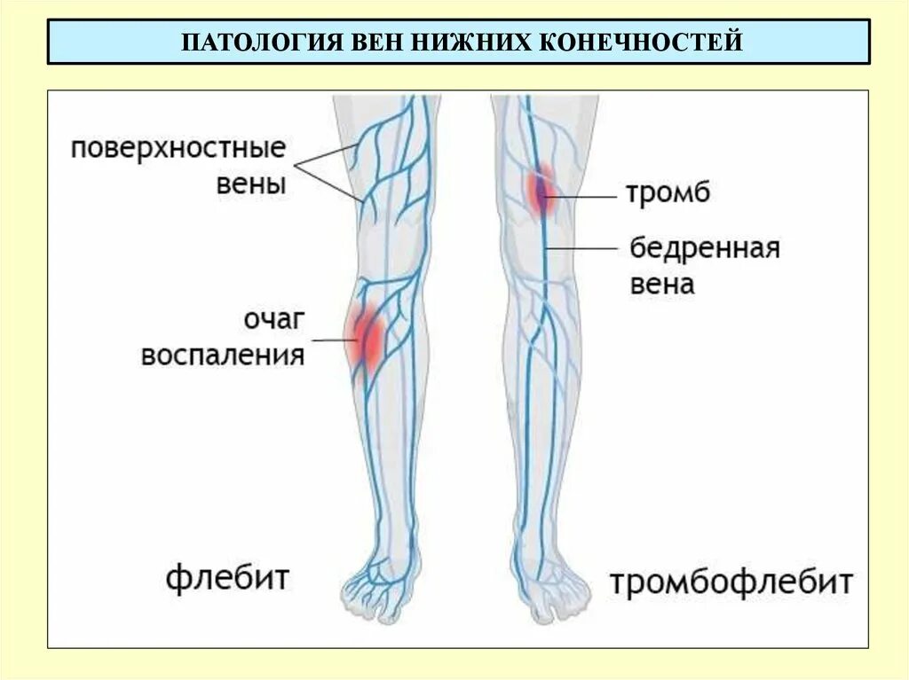 Размеры тромбов. Поверхностная бедренная Вена тромбоз. Флебит поверхностной вены. Тромбофлебит бедренной вены. Флебит вен нижних конечностей.