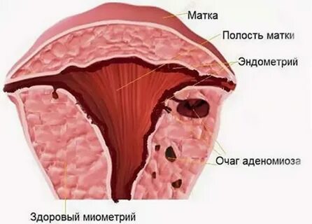 Аденомиоз матки что это простыми
