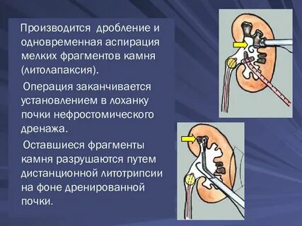 Раздробленная почка