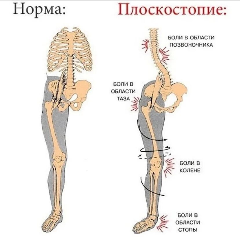 Влияние плоскостопия на коленные суставы. Косолапие и плоскостопие. Стопа и позвоночник. Осложнения плоскостопия.