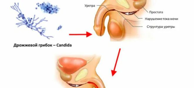 Кандидозный уретрит у мужчин. Грибковое размножение у мальчиков. Покраснение уретры у мужчин. Покраснение губок уретры у мужчин причины фото.
