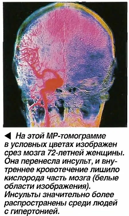 Brain 72. Гиперденсивность в МР это.