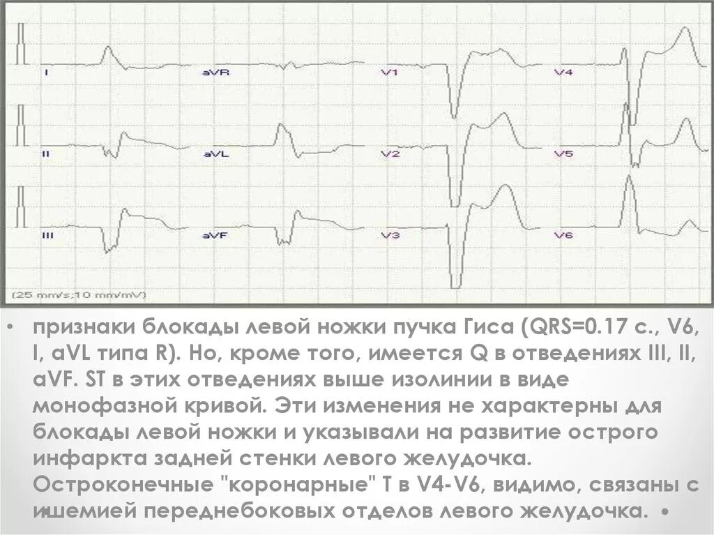 Полная блокада пучка ножки гиса лечение. Блокада левой ножки пучка Гиса на ЭКГ. ЭКГ при блокаде левой ножки пучка Гиса. Блокада ПВВ левой ножки пучка Гиса. Блокада левой ножки пучка Гиса и правой ножки.