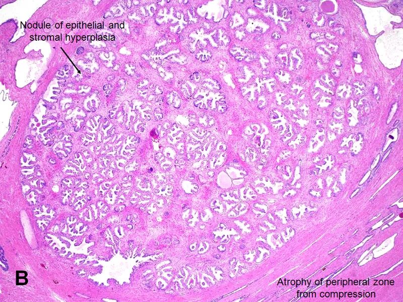 Железистая гиперплазия предстательной железы. Аденома предстательной железы гистология. Аденокарцинома предстательной железы гистология. Гиперплазия предстательной железы гистология. Железистая гиперплазия гистология.