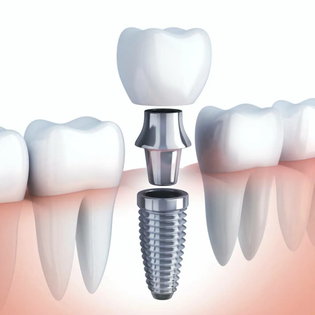 имплантация прайс. что такое импланты зубов в стоматологии. акция на имплантацию зубов. имплант с коронкой под ключ. имплантация прайс.