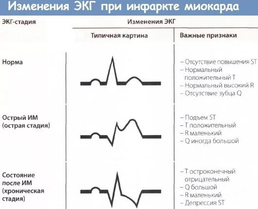 Диффузные изменения экг что это значит. ЭКГ при разных стадиях инфаркта миокарда. Метаболические нарушения в миокарде на ЭКГ. Периоды инфаркта миокарда ЭКГ изменения. Рубцовые изменения миокарда на ЭКГ.