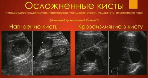 Диагностика кист