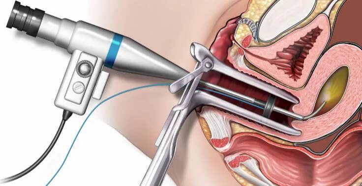 Операция полипы сколько стоит. Полип эндометрия гистероскопия. Полип эндометрия гистероскоп. Операция гистероскопия матки. Гистероскопия эндометриоз.