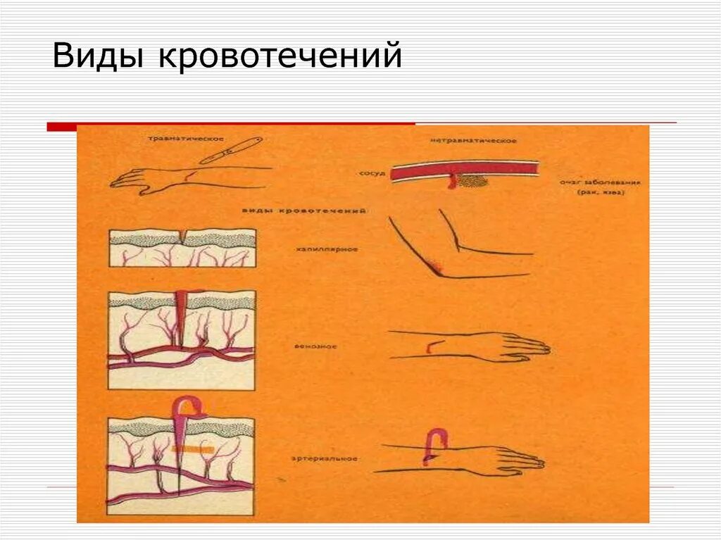 Кровотечение и гемостаз. Гемостаз виды кровотечений. Кровотечение и гемостаз презентация.