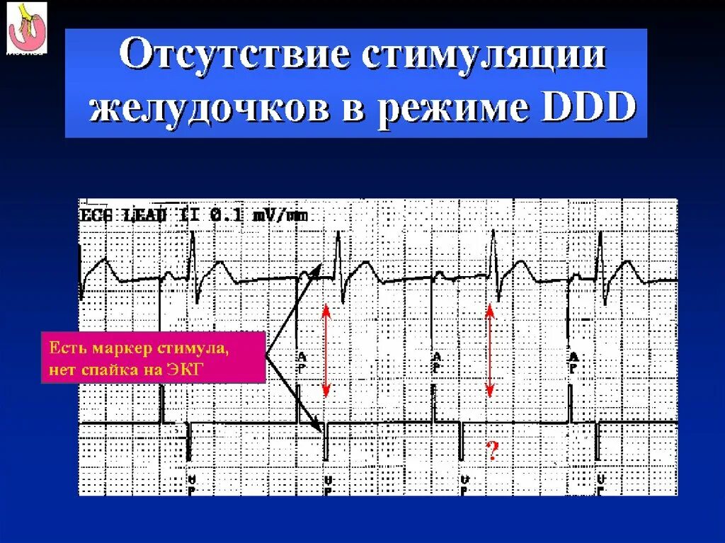 Р синхронизированная стимуляция желудочков на экг. Стимуляция желудочков. Предсердная стимуляция экс. Р синхронизированная стимуляция желудочков на экг. Синхронизированная стимуляция желудочков на экг экс.