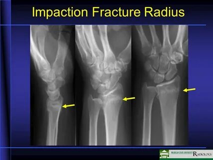 Андроид fracture