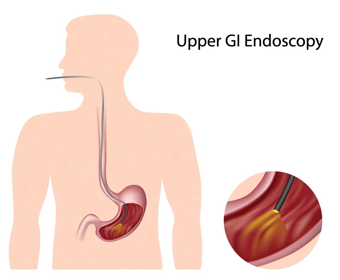 Еда стоит в пищеводе. Гастроскопия желудка гастрит. Эндоскопия пищевода и желудка. Язва желудка гастроскопия.