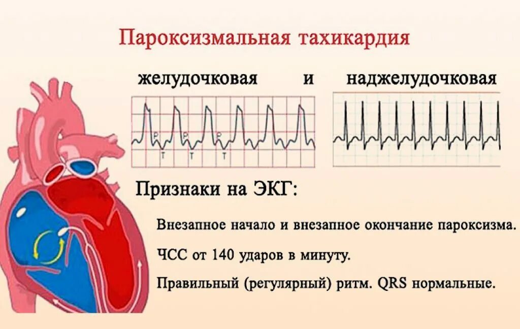 Тахикардия симптомы лечение у взрослых. Экг при пароксизмальной тахикардии. пароксизм наджелудочковая тахикардия экг. суправентрикулярная пароксизмальная тахикардия на экг. пароксизмальная желудочковая тахикардия на экг.