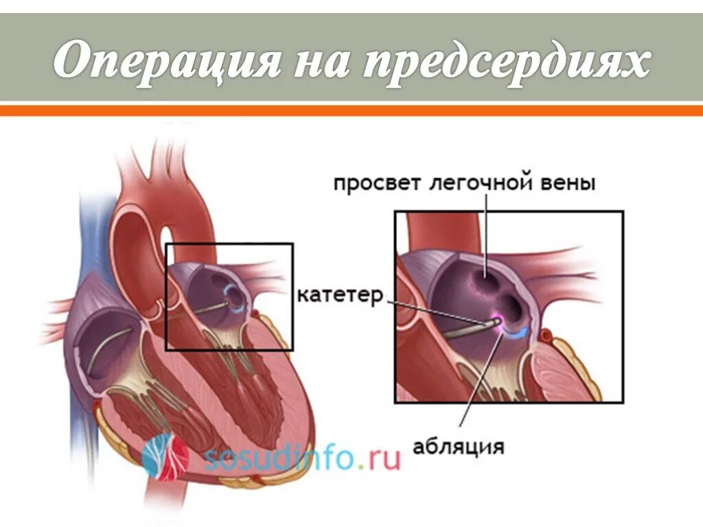 Радиочастотная катетерная абляция (РЧА). Катетерная абляция сердца что это такое. Радиочастотная катетерная абляция фибрилляции предсердий. Радиочастотная катетерная абляция легочных вен. Изоляция легочной вены