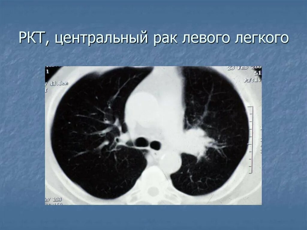 РКТ легких. Рентгеновская томография легких. Корень легкого на кт. Центральный рак правого