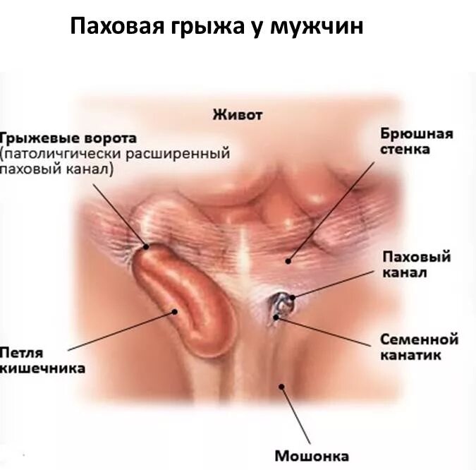 Паховая мошоночная грыжа. Грыжевые ворота паховой грыжи. Грида в паховой области. Боли в правой области паха