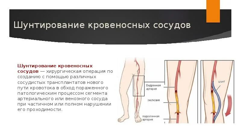 Артерия ноги операция